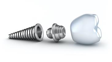 A dental implant