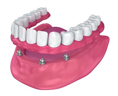 An illustration of a denture