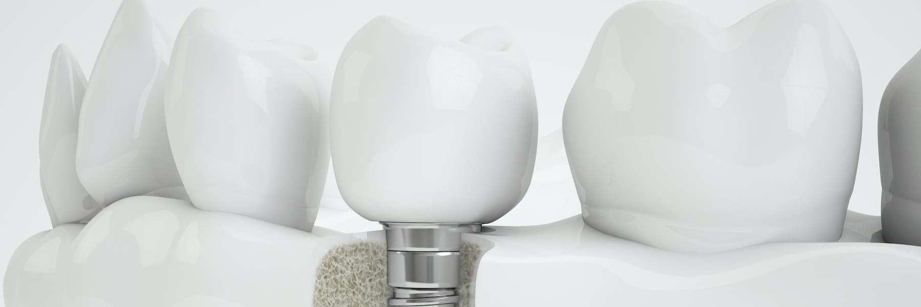 An illustration of a dental implant in Audubon, NJ