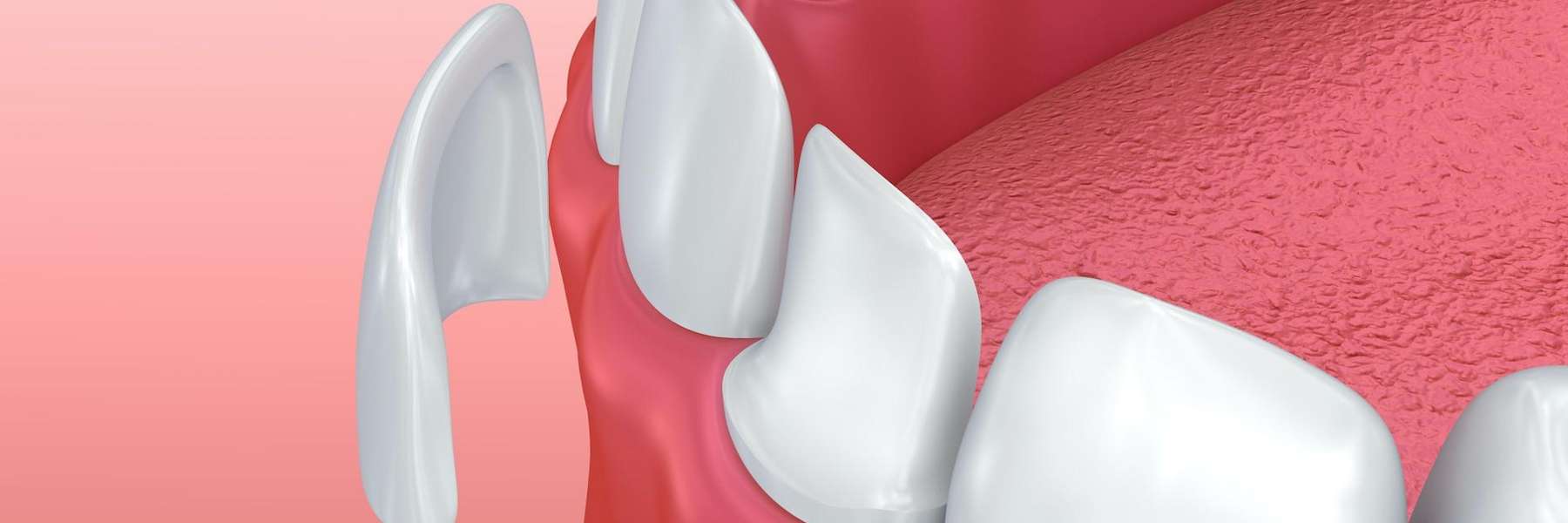 An Illustration of a Porcelain Veneers in Audubon, Nj