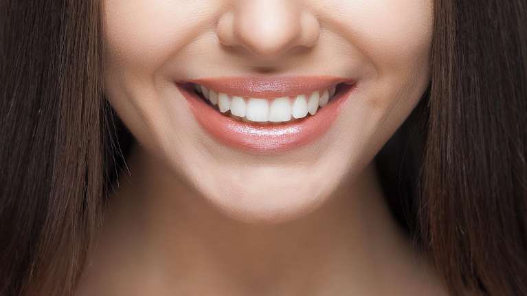 A woman with Tooth-Colored Fillings in Audubon, NJ