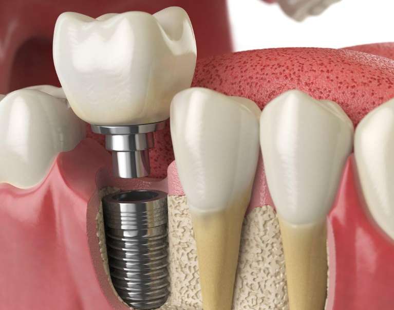 An illustration of a Dental implant in Audubon, NJ