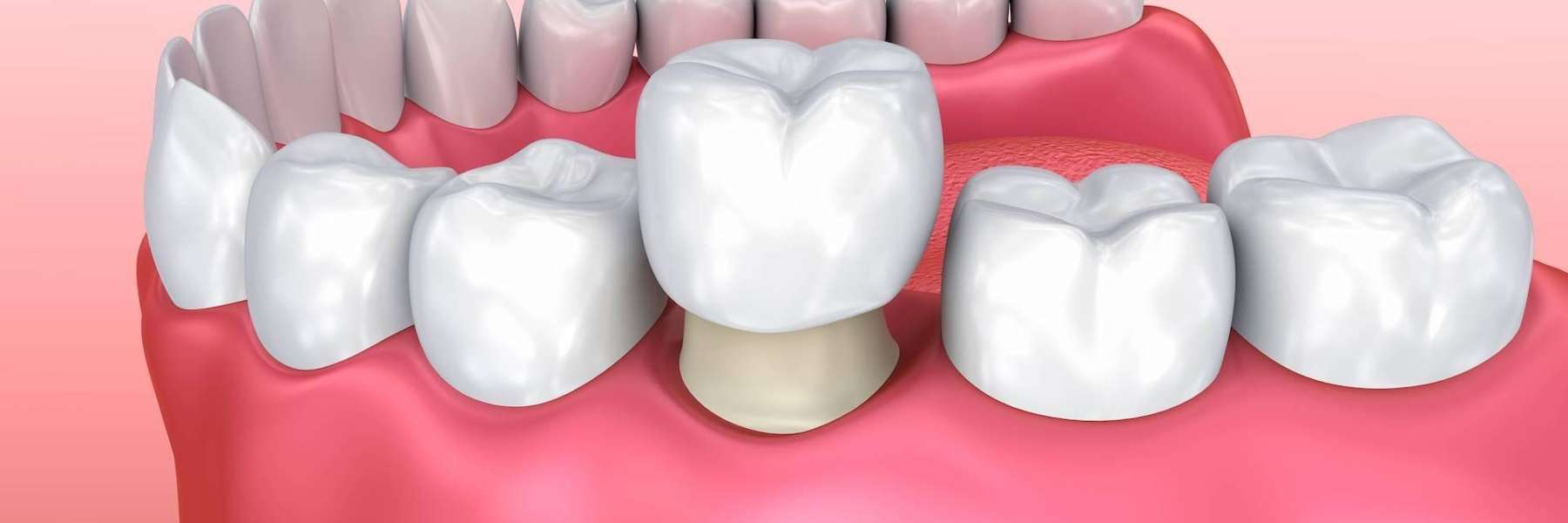 Photo of an illustration of a dental crown at Train Station Dental, NJ