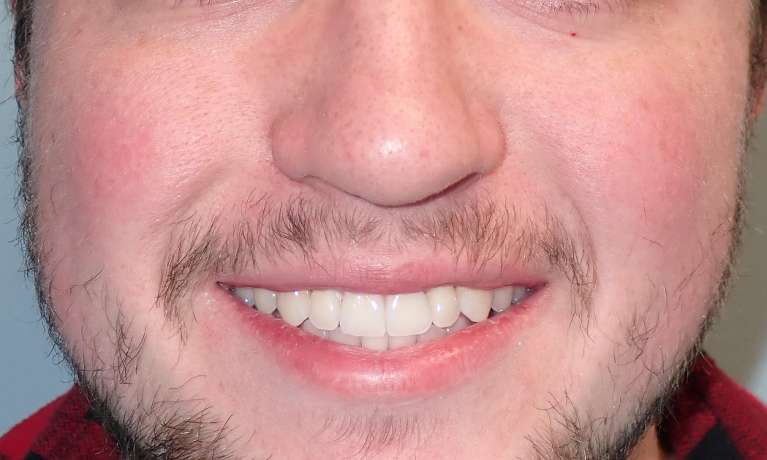 A patient's teeth after Invisalign at Train Station Dental, NJ