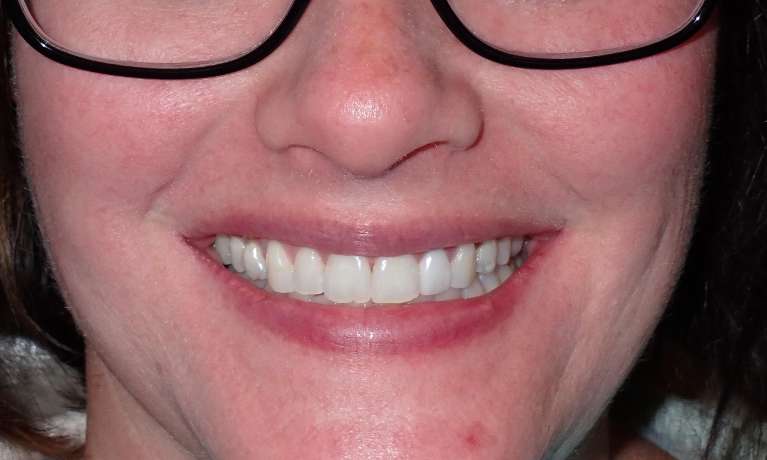 Invisalign-and-Teeth-Whitening-After-Image