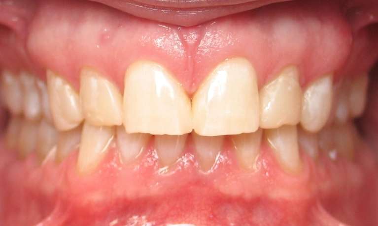 Patient's teeth After whitening in Audubon, NJ.