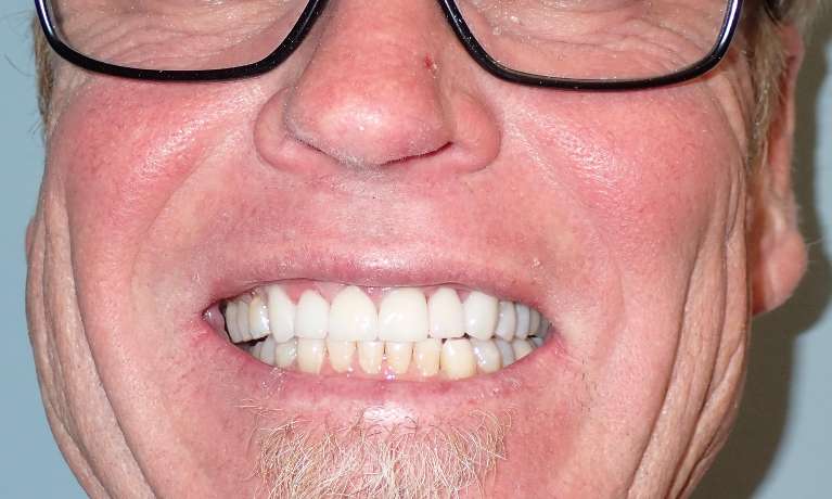 photo of a patient's teeth after getting Porcelain Crowns at Train Station Dental, NJ
