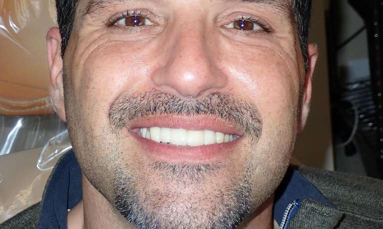 A photo of patient's teeth after dental implant in Audubon, NJ.