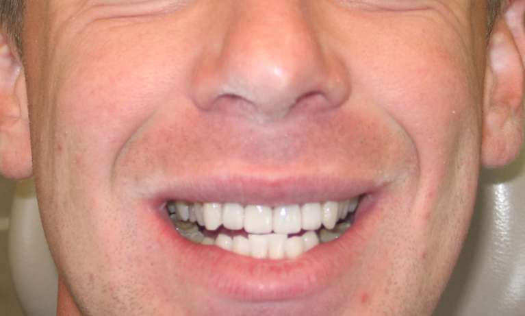 A photo of a patient after getting Porcelain veneers in Audobon, NJ