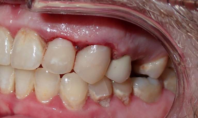 Patient's teeth after getting Esthetic Bonding