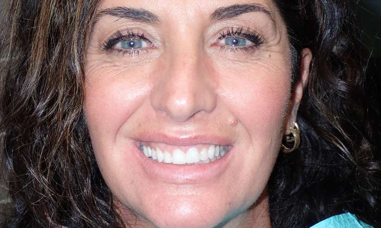 Patient's teeth After using invisalign in Audubon, NJ.