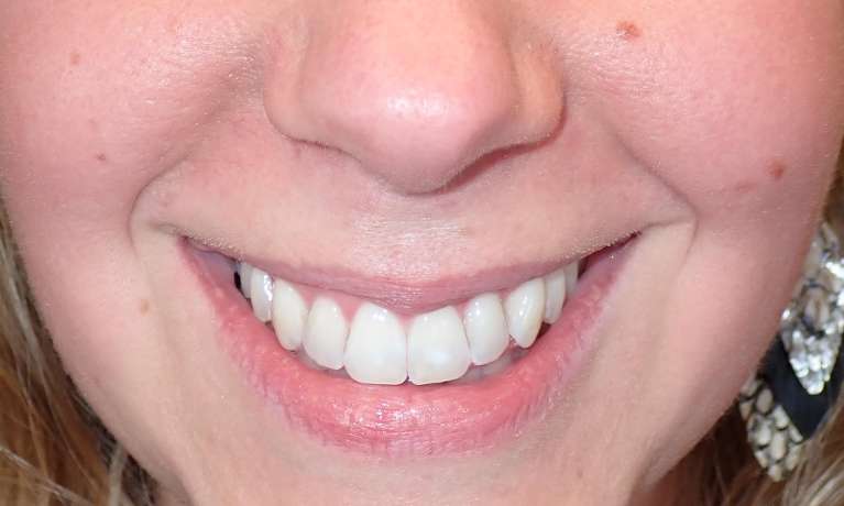 Invisalign-to-Close-an-Open-Bite-After-Image