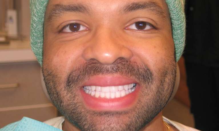 Photo of patient's teeth after applying Invisalign in Train Station Dental, NJ