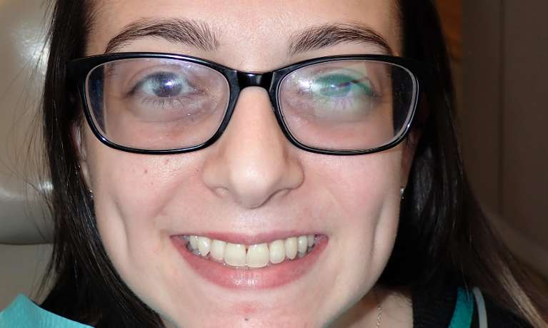 Patient's teeth after getting Invisalign clear aligners at Train Station Dental, NJ