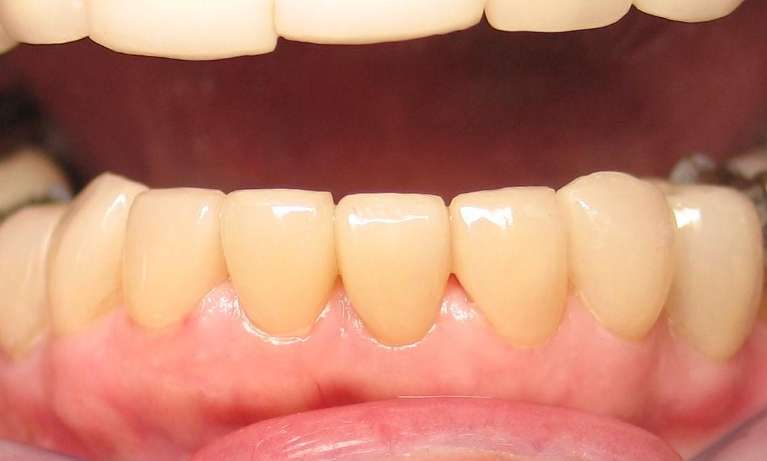 A photo of a patient's teeth after getting Porcelain crowns at Train Station Dental, NJ