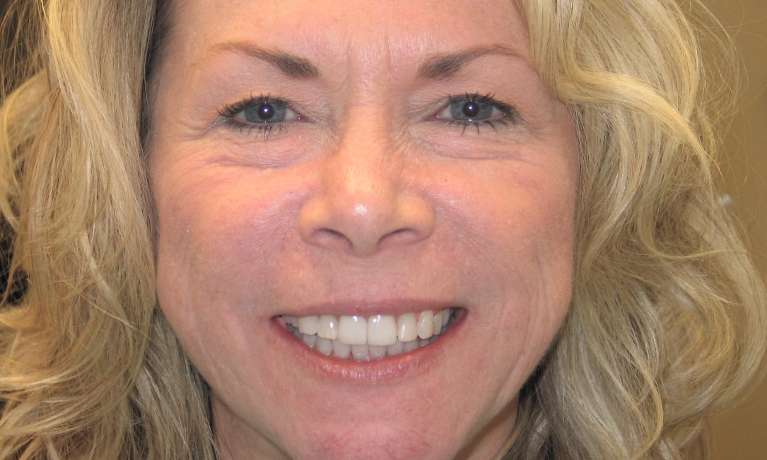 Patient's teeth after porcelain veneers and Invisalign at Train Station, NJ