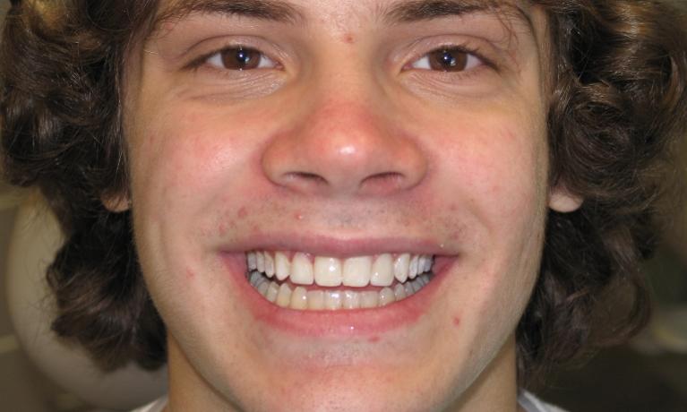 After- Radiant smile with the aid of beautiful porcelain veneers