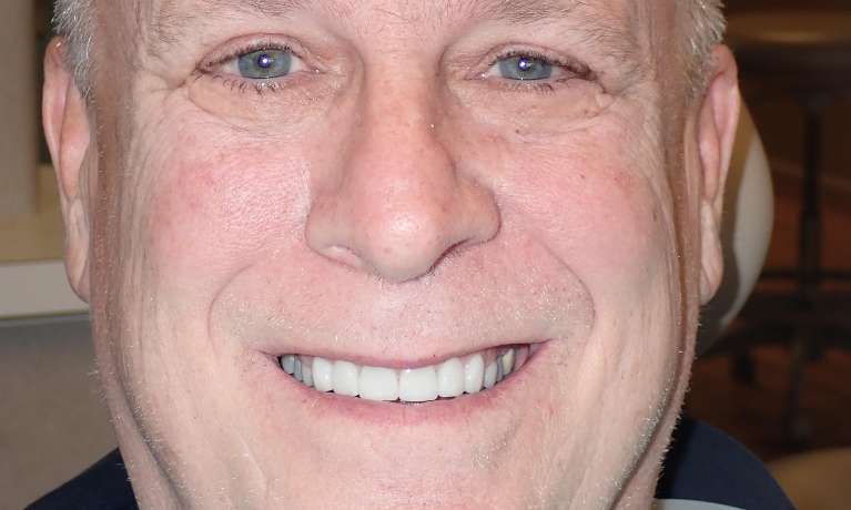Photo of a patient after getting porcelain veneers in Train Station Dental, NJ