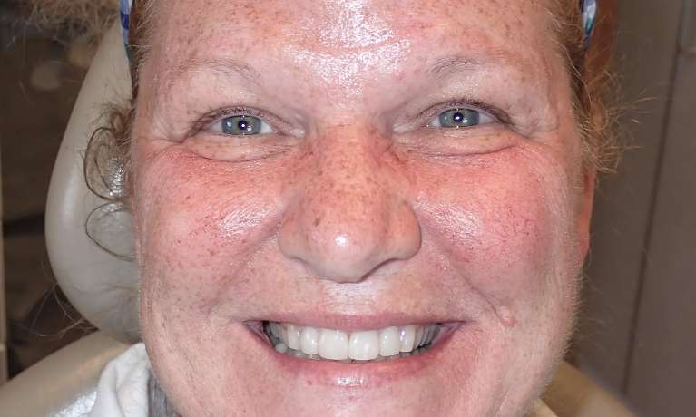 Patient's teeth after getting porcelain veneers in Audubon, NJ