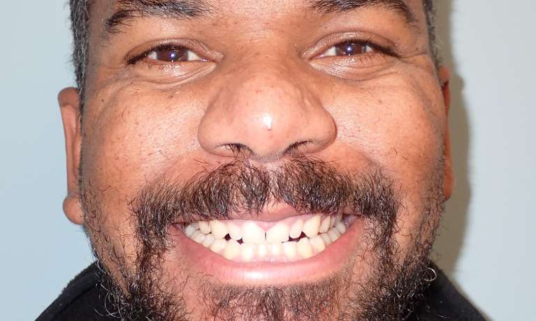 Patient's teeth after closure with Invisalign at Train Station Dental, NJ