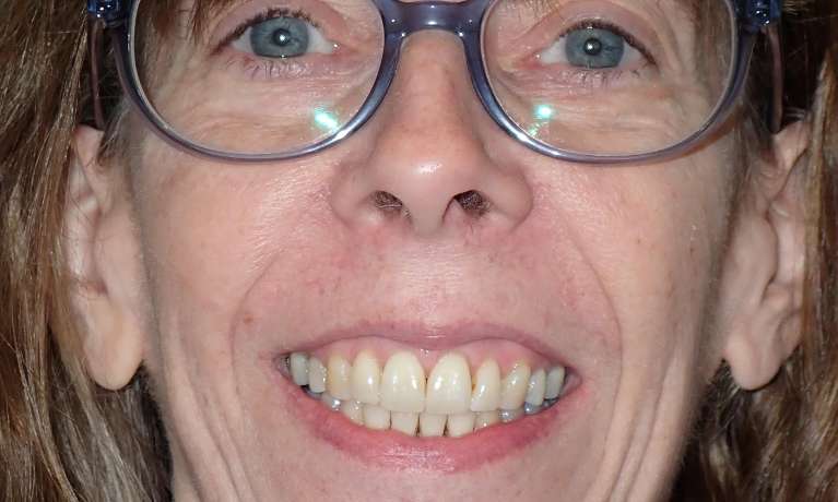 Photo of patient's teeth after Invisalign in Audubon,Nj