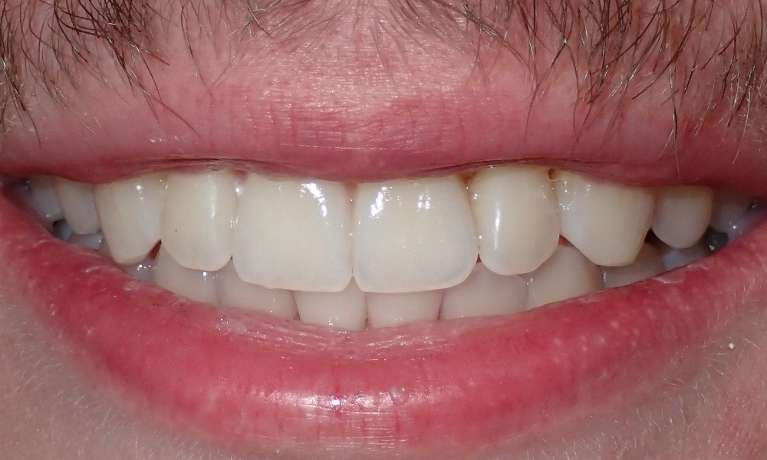 A patient's teeth after Invisalign at Train Station Dental, NJ