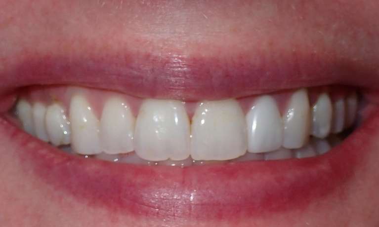 Close up after picture of beautiful result with Invisalign and Teeth Whitening