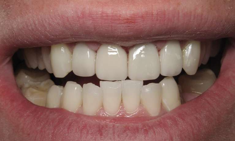 A photo of a patient after getting Porcelain veneers in Audobon, NJ