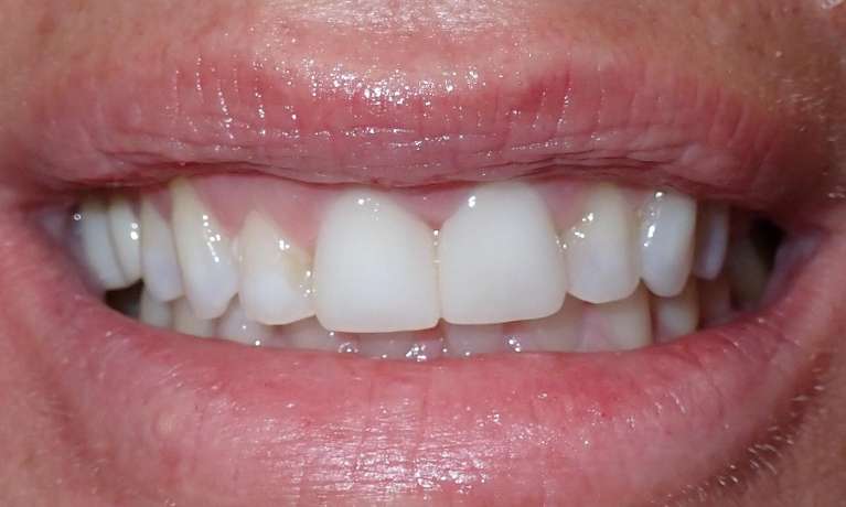 Patient's teeth after using Porcelain Veneers in Audubon, NJ.
