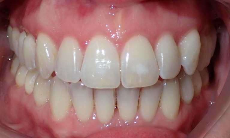 A close up after picture of a patient after Invisalign treatment to correct an open Bite