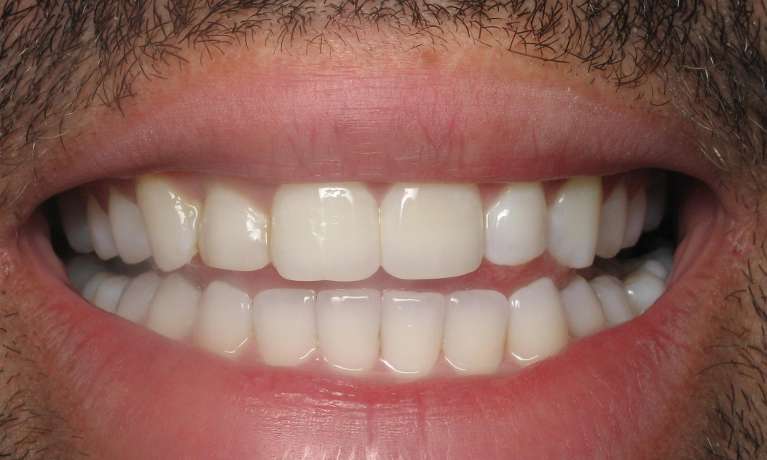 Photo of patient's teeth after applying Invisalign in Train Station Dental, NJ