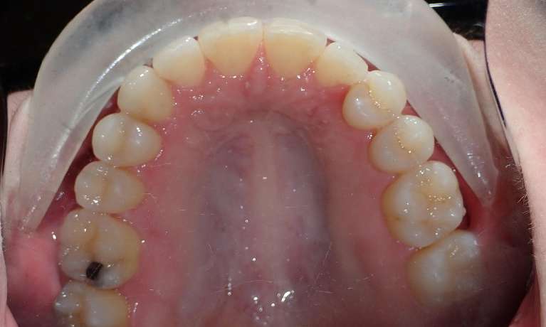 Patient's teeth after getting Invisalign clear aligners at Train Station Dental, NJ
