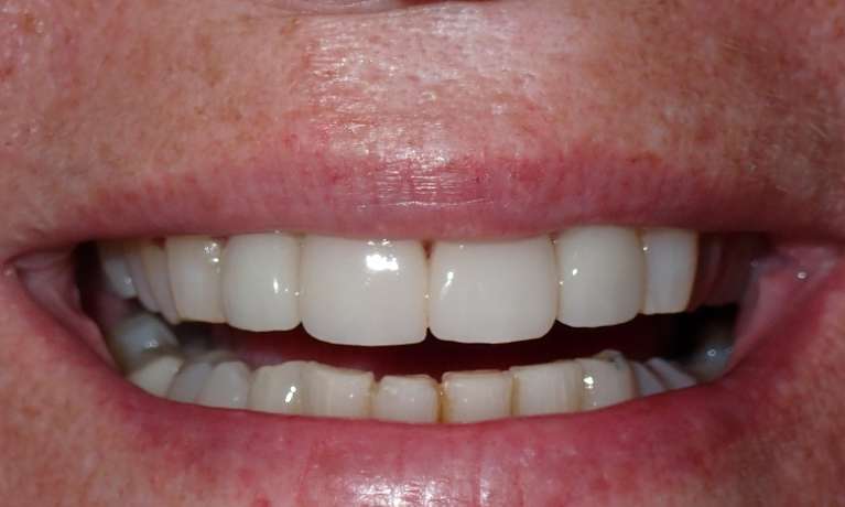 Patient's teeth after getting porcelain veneers in Audubon, NJ