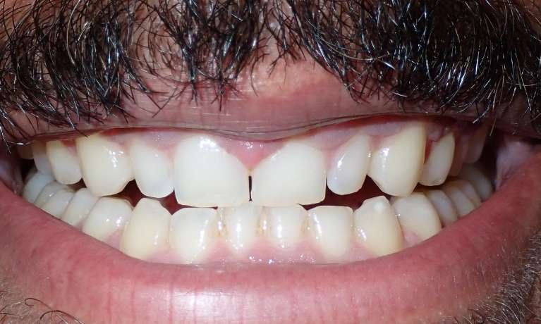 Patient's teeth after space closure with Invisalign at Train Station Dental, NJ