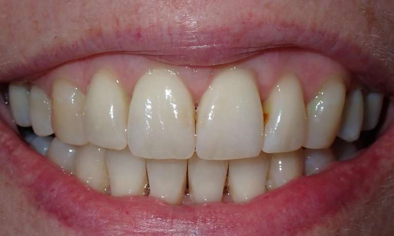 Photo of patient's teeth after Invisalign in Audubon,Nj