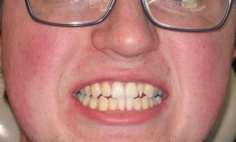 A patient's teeth before Invisalign