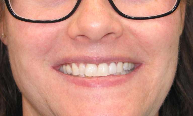 Invisalign-and-Teeth-Whitening-Before-Image
