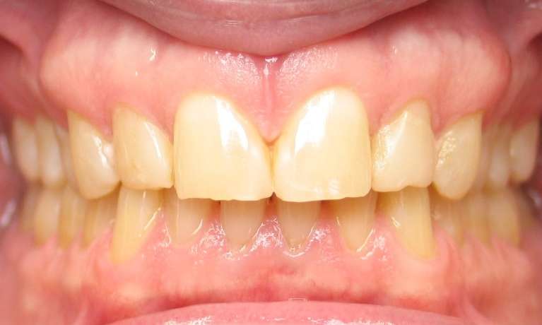 Patient's teeth before whitening in Audubon, NJ.