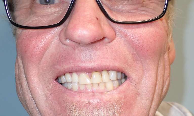 Photo of a patient's teeth before getting Porcelain Crowns