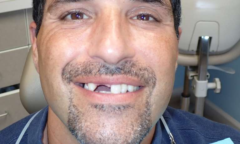 A photo of patient's teeth before dental implant in Audubon, NJ.