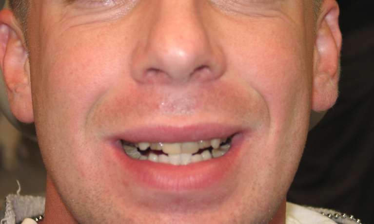 A photo of a patient's teeth before getting Porcelain veneers