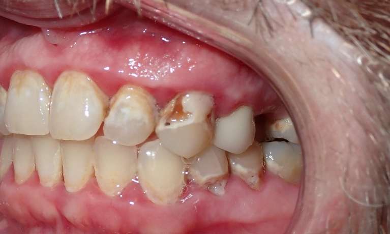 Patient's teeth before getting Esthetic Bonding
