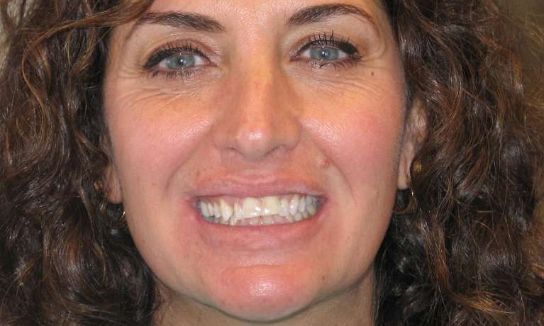 Patient's teeth before using invisalign in Audubon, NJ.