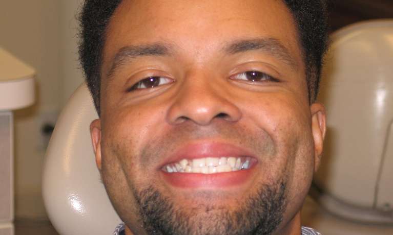 Patient's teeth before Invisalign
