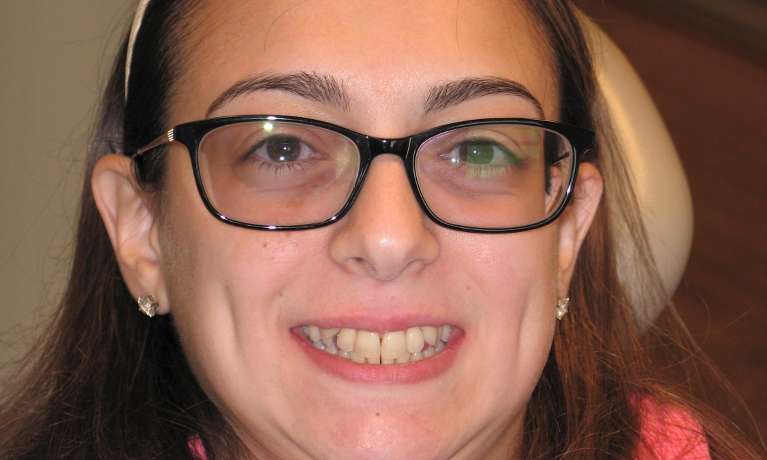 Patient's teeth before getting Invisalign clear aligners