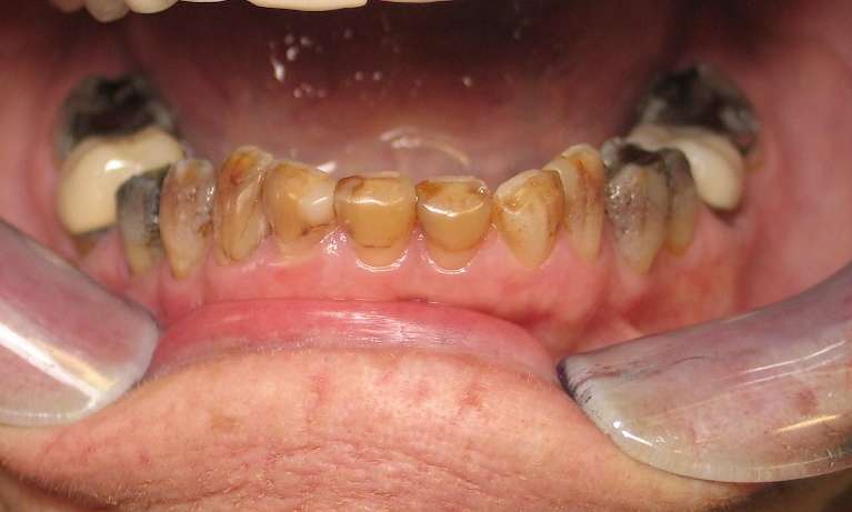 A photo of a patient's worn teeth before getting Porcelain crowns at Train Station Dental, NJ