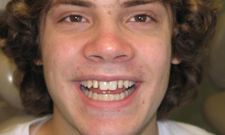 Before- Patient was displeased with small lateral incisors