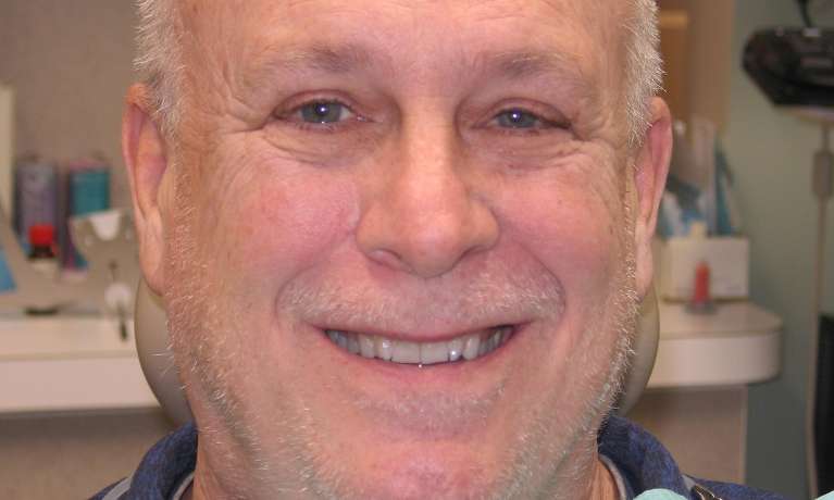 Photo of a patient before getting porcelain veneers in Train Station Dental, NJ