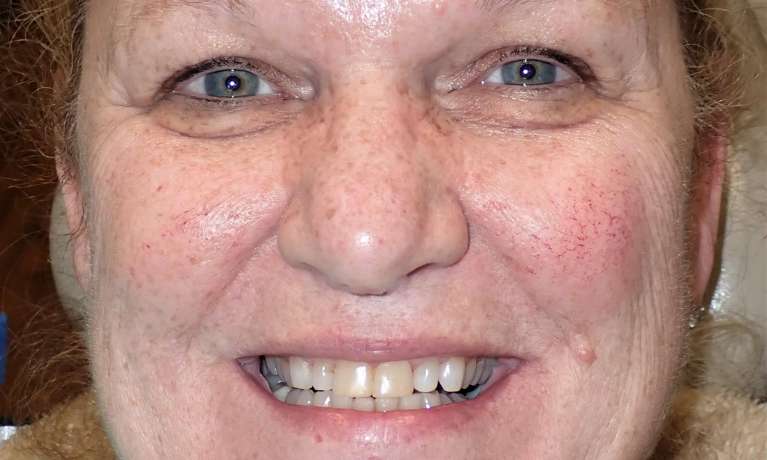 Patient's teeth before getting porcelain veneers