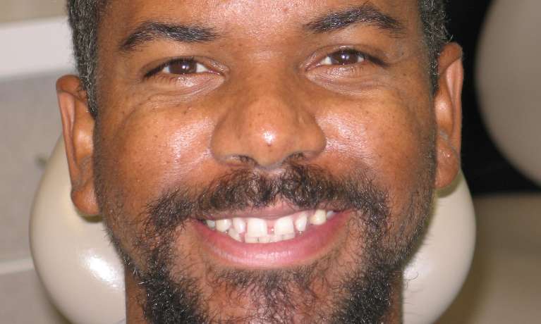 Patient's teeth before space closure
